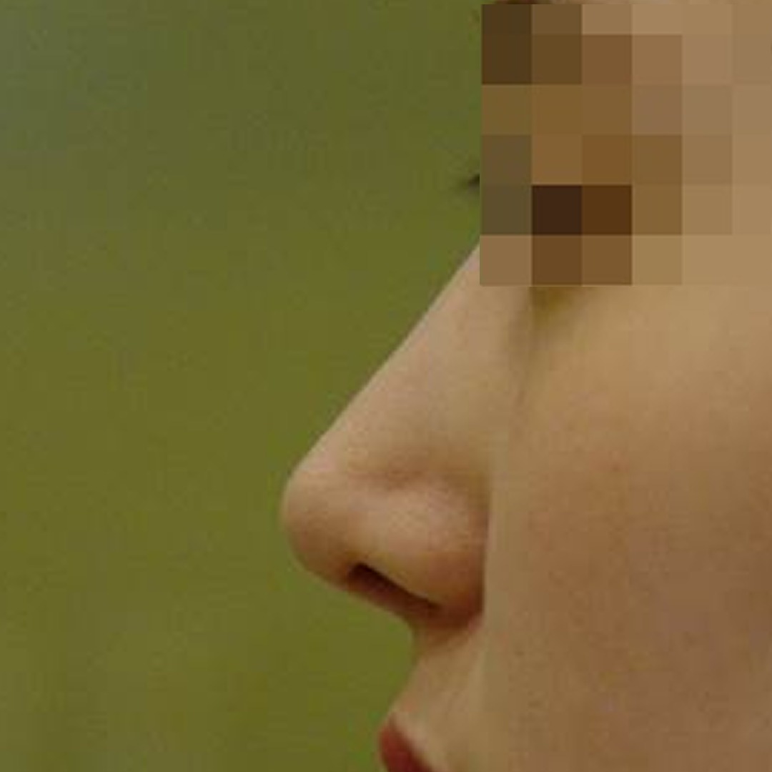 수술 후